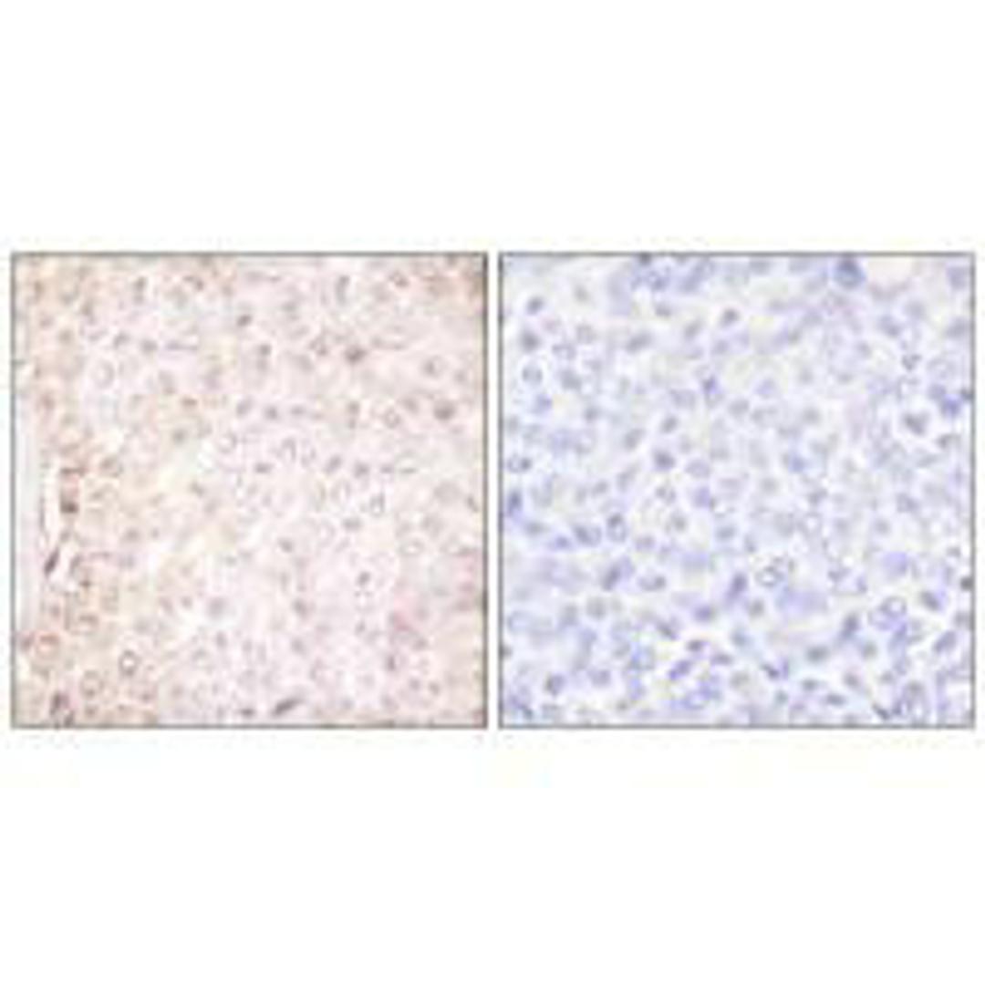 Immunohistochemical analysis of paraffin-embedded human breast carcinoma tissue using Stefin B antibody.