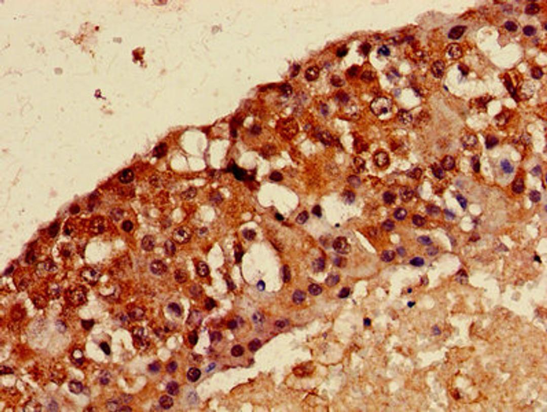 Immunohistochemistry of paraffin-embedded human breast cancer using CSB-PA013334LA01HU at dilution of 1:100