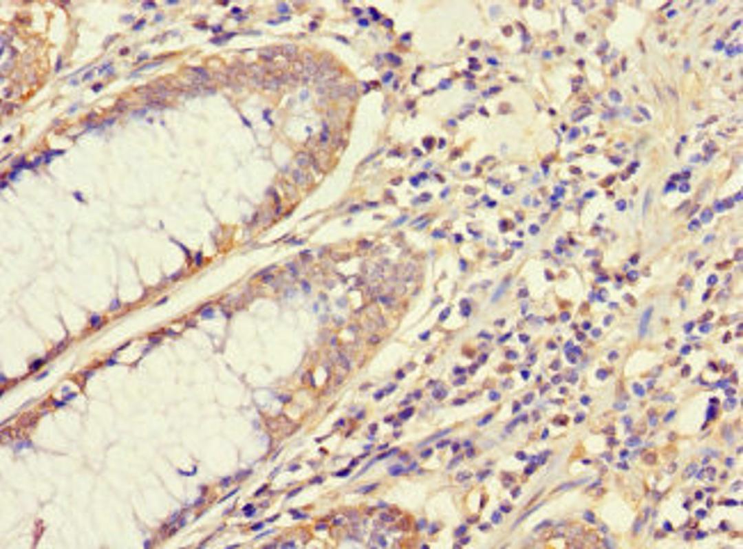 Immunohistochemistry of paraffin-embedded human colon cancer using CSB-PA15499A0Rb at dilution of 1:100