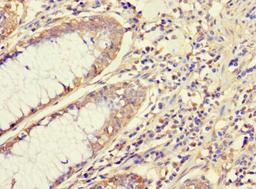 Immunohistochemistry of paraffin-embedded human colon cancer using CSB-PA15499A0Rb at dilution of 1:100