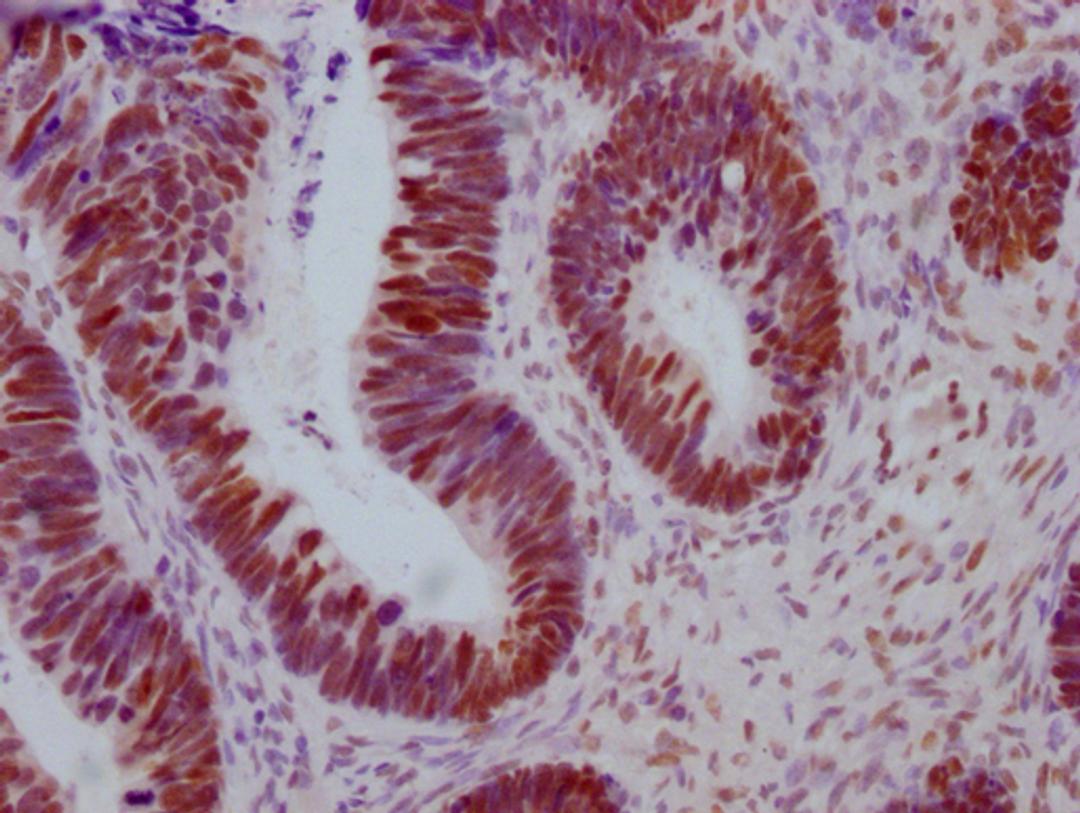 IHC image of CSB-MA442659 diluted at 1:100 and staining in paraffin-embedded human ovarian cancer performed on a Leica BondTM system. After dewaxing and hydration, antigen retrieval was mediated by high pressure in a citrate buffer (pH 6.0). Section was blocked with 10% normal goat serum 30min at RT. Then primary antibody (1% BSA) was incubated at 4°C overnight. The primary is detected by a Goat anti-mouse IgG polymer labeled by HRP and visualized using 0.05% DAB.