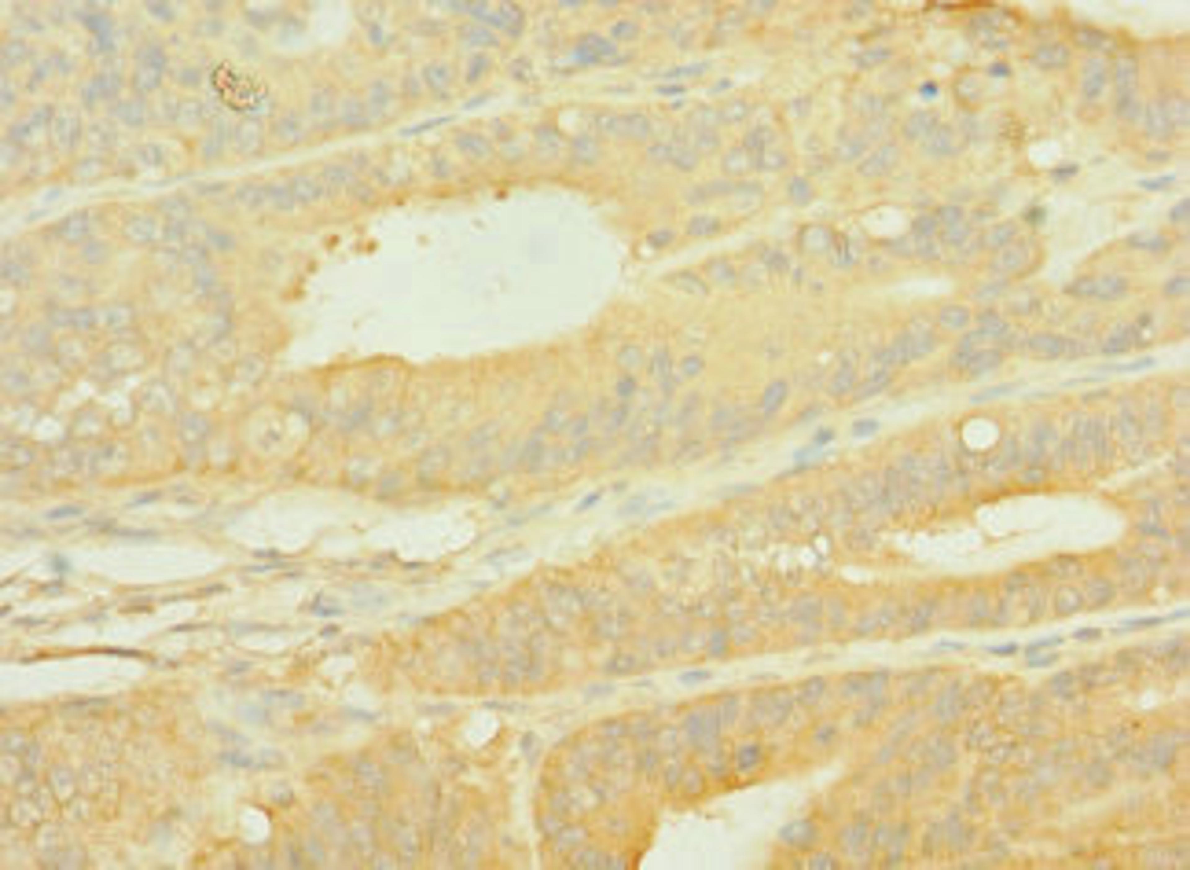 Immunohistochemistry of paraffin-embedded human endometrial cancer using CSB-PA622519LA01HU at dilution of 1:100