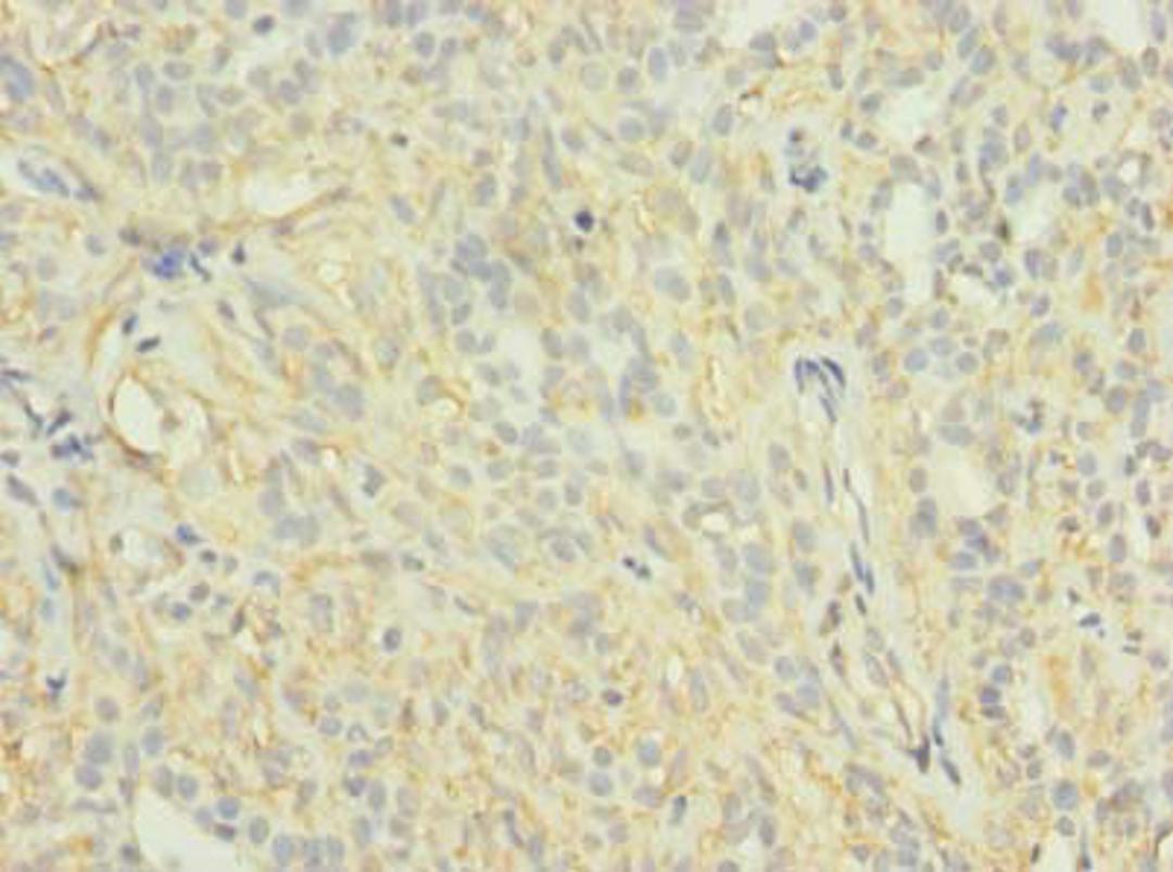 Immunohistochemistry of paraffin-embedded human breast cancer using CSB-PA878877LA01HU at dilution of 1:100