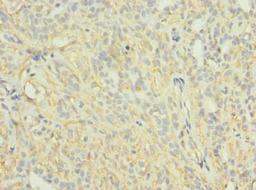 Immunohistochemistry of paraffin-embedded human breast cancer using CSB-PA878877LA01HU at dilution of 1:100