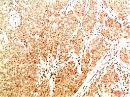 Immunohistochemical analysis of paraffin-embedded Human Breast Carcinoma Tissue using Acetyl NF kB P65(K314/K315)  Mouse mAb diluted at 1:200.