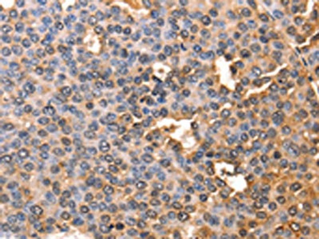 The image on the left is immunohistochemistry of paraffin-embedded Human liver cancer tissue using CSB-PA787484(AFP Antibody) at dilution 1/60, on the right is treated with fusion protein. (Original magnification: ×200)
