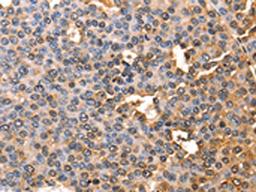 The image on the left is immunohistochemistry of paraffin-embedded Human liver cancer tissue using CSB-PA787484(AFP Antibody) at dilution 1/60, on the right is treated with fusion protein. (Original magnification: ×200)