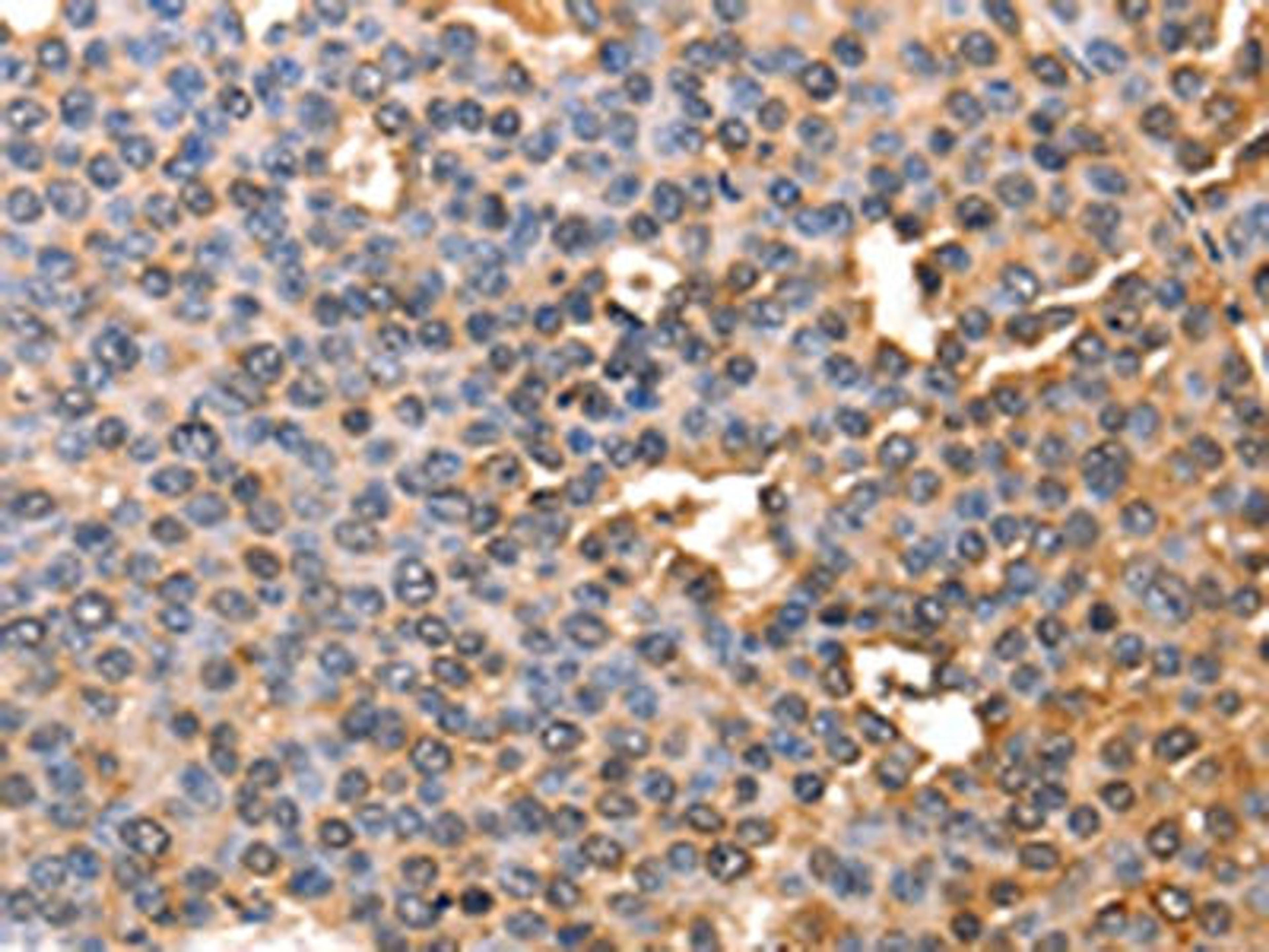 The image on the left is immunohistochemistry of paraffin-embedded Human liver cancer tissue using CSB-PA787484(AFP Antibody) at dilution 1/60, on the right is treated with fusion protein. (Original magnification: ×200)