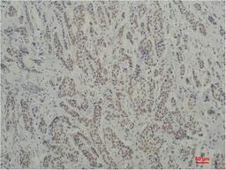 Immunohistochemical analysis of paraffin-embedded Human Breast Carcinoma using TBP/TATA Binding Protein(mAb diluted at 1:200.