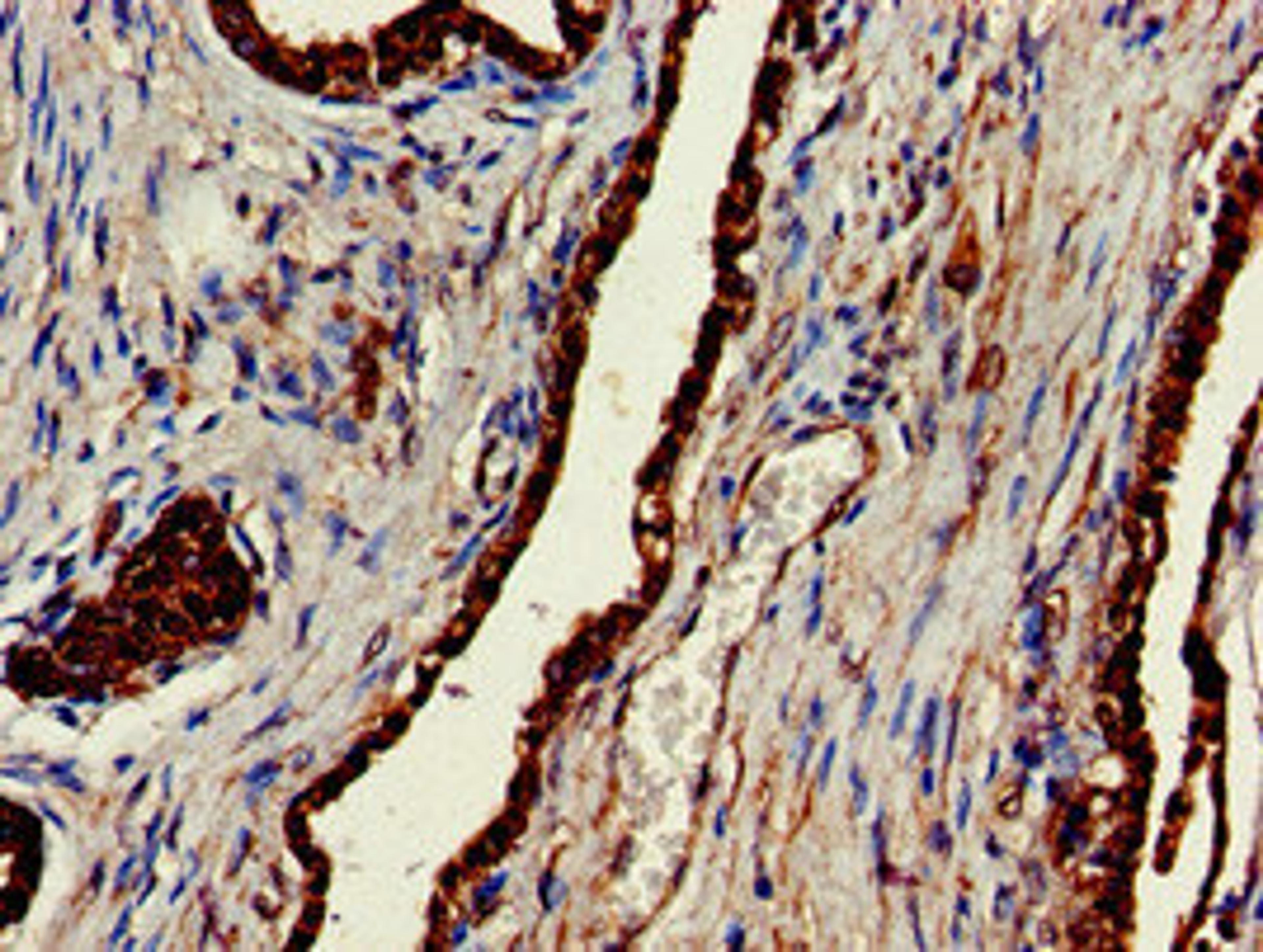 Immunohistochemistry of paraffin-embedded human prostate cancer using CSB-PA005552LA01HU at dilution of 1:100