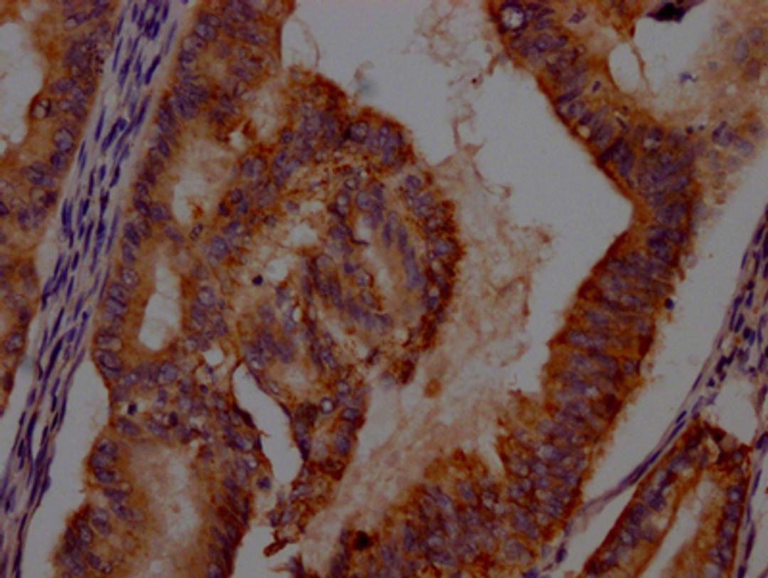 IHC image of CSB-RA215054A0HU diluted at 1:100 and staining in paraffin-embedded human endometrial cancer performed on a Leica BondTM system. After dewaxing and hydration, antigen retrieval was mediated by high pressure in a citrate buffer (pH 6.0). Section was blocked with 10% normal goat serum 30min at RT. Then primary antibody (1% BSA) was incubated at 4℃ overnight. The primary is detected by a Goat anti-rabbit IgG polymer labeled by HRP and visualized using 0.05% DAB.