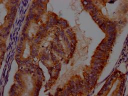 IHC image of CSB-RA215054A0HU diluted at 1:100 and staining in paraffin-embedded human endometrial cancer performed on a Leica BondTM system. After dewaxing and hydration, antigen retrieval was mediated by high pressure in a citrate buffer (pH 6.0). Section was blocked with 10% normal goat serum 30min at RT. Then primary antibody (1% BSA) was incubated at 4℃ overnight. The primary is detected by a Goat anti-rabbit IgG polymer labeled by HRP and visualized using 0.05% DAB.