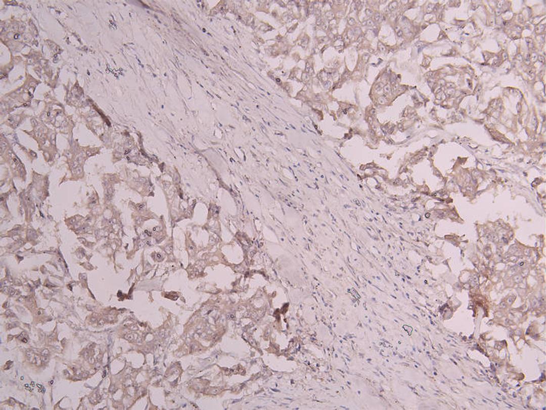 IHC image of CSB-RA801238MA1HU diluted at 1:300 and staining in paraffin-embedded human breast cancer performed on a Leica BondTM system. After dewaxing and hydration, antigen retrieval was mediated by high pressure in a citrate buffer (pH 6.0). Section was blocked with 10% normal goat serum 30min at RT. Then primary antibody (1% BSA) was incubated at 4°C overnight. The primary is detected by a Goat anti-human polymer IgG labeled by HRP and visualized using 0.05% DAB.