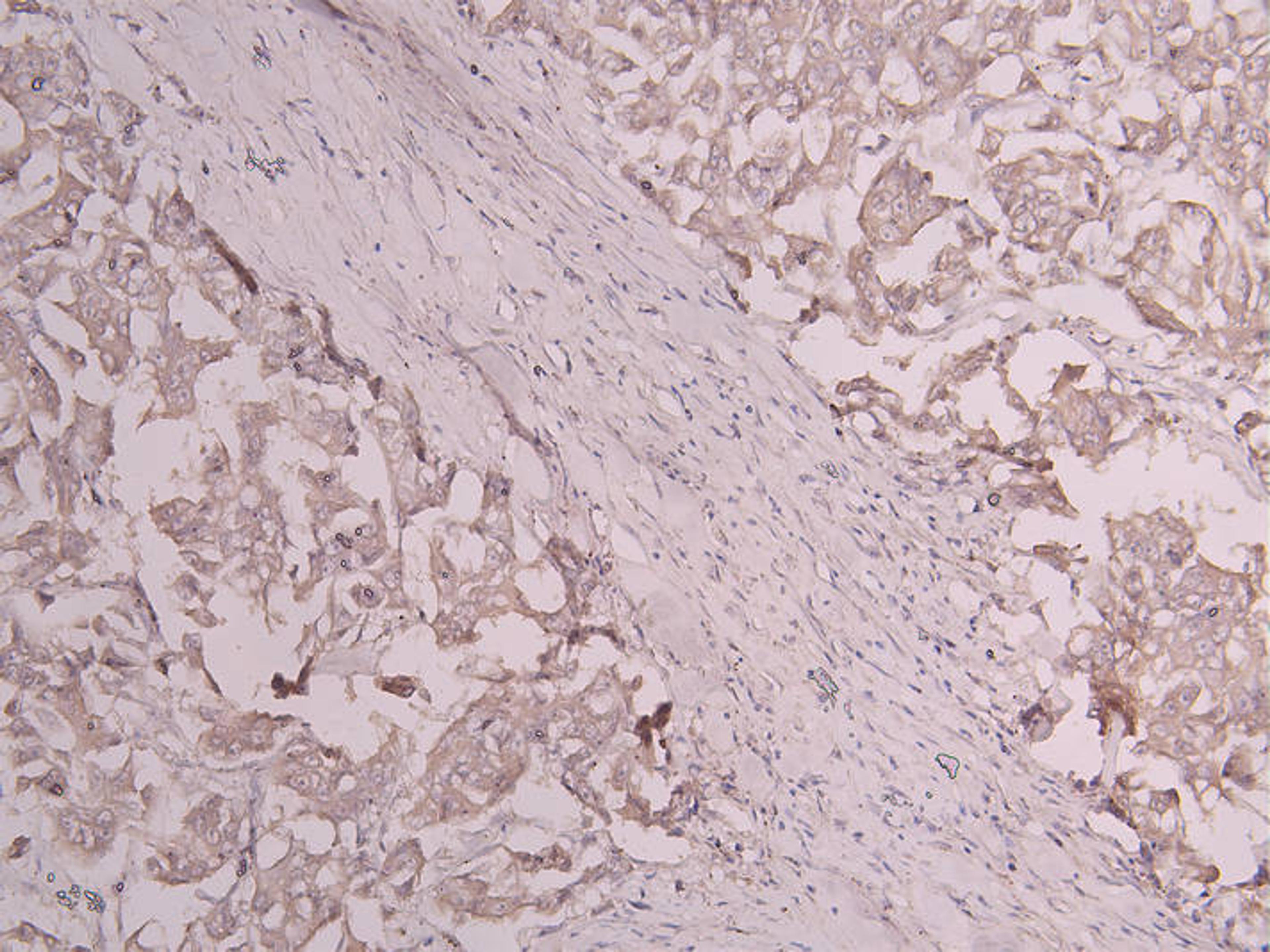 IHC image of CSB-RA801238MA1HU diluted at 1:300 and staining in paraffin-embedded human breast cancer performed on a Leica BondTM system. After dewaxing and hydration, antigen retrieval was mediated by high pressure in a citrate buffer (pH 6.0). Section was blocked with 10% normal goat serum 30min at RT. Then primary antibody (1% BSA) was incubated at 4°C overnight. The primary is detected by a Goat anti-human polymer IgG labeled by HRP and visualized using 0.05% DAB.