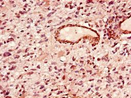 Immunohistochemistry of paraffin-embedded human glioma using CSB-PA012975LA01HU at dilution of 1:100