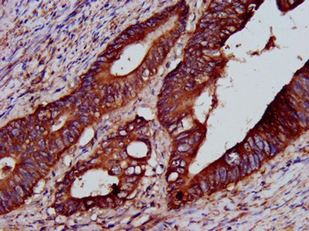 IHC image of CSB-PA613277LA01HU diluted at 1:200 and staining in paraffin-embedded human colon cancer performed on a Leica BondTM system. After dewaxing and hydration, antigen retrieval was mediated by high pressure in a citrate buffer (pH 6.0). Section was blocked with 10% normal goat serum 30min at RT. Then primary antibody (1% BSA) was incubated at 4&deg;C overnight. The primary is detected by a biotinylated secondary antibody and visualized using an HRP conjugated SP system.