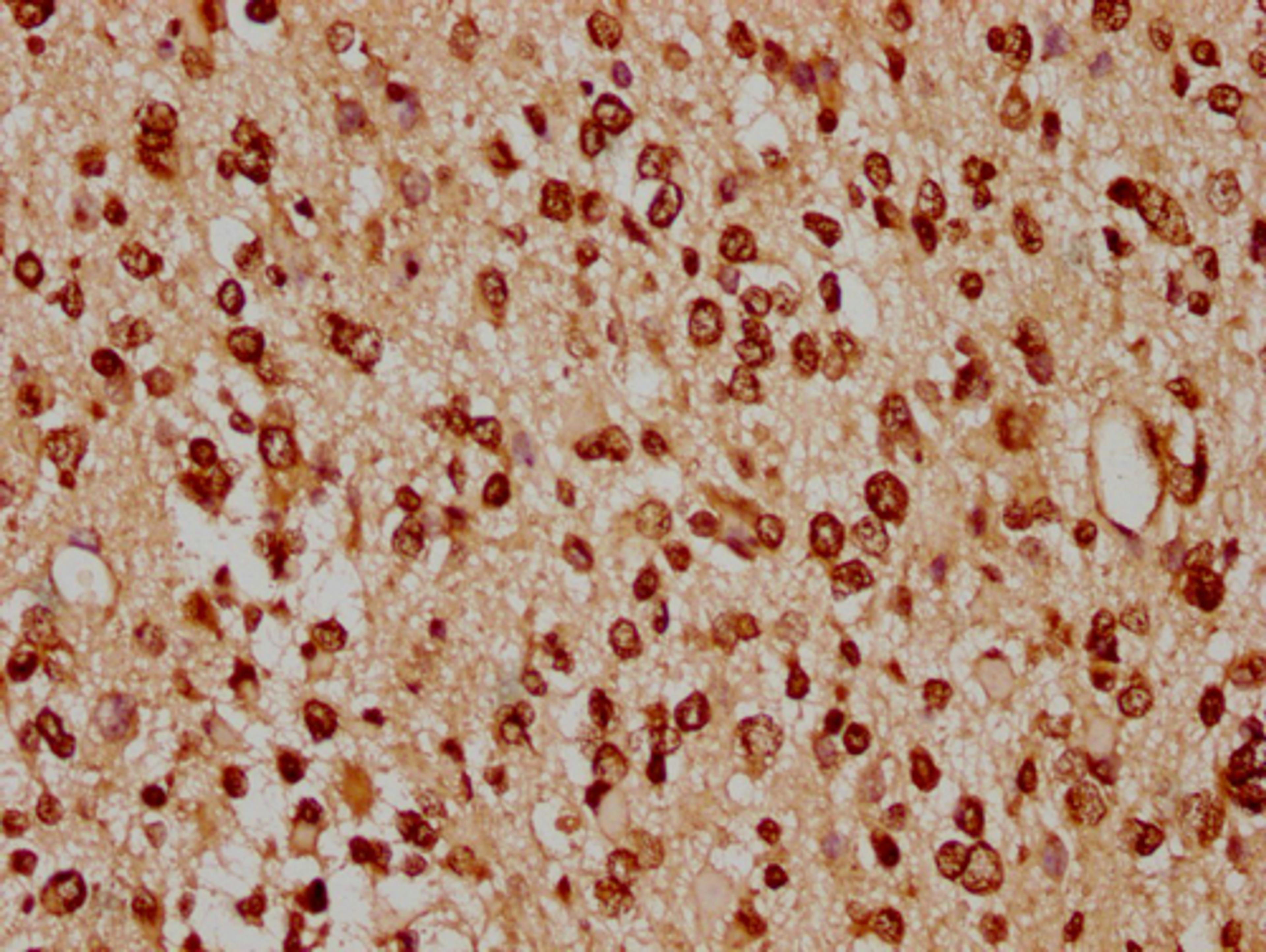 IHC image of CSB-PA010429PA91nacHU diluted at 1:20 and staining in paraffin-embedded human glioma cancer performed on a Leica BondTM system. After dewaxing and hydration, antigen retrieval was mediated by high pressure in a citrate buffer (pH 6.0). Section was blocked with 10% normal goat serum 30min at RT. Then primary antibody (1% BSA) was incubated at 4°C overnight. The primary is detected by a biotinylated secondary antibody and visualized using an HRP conjugated SP system.