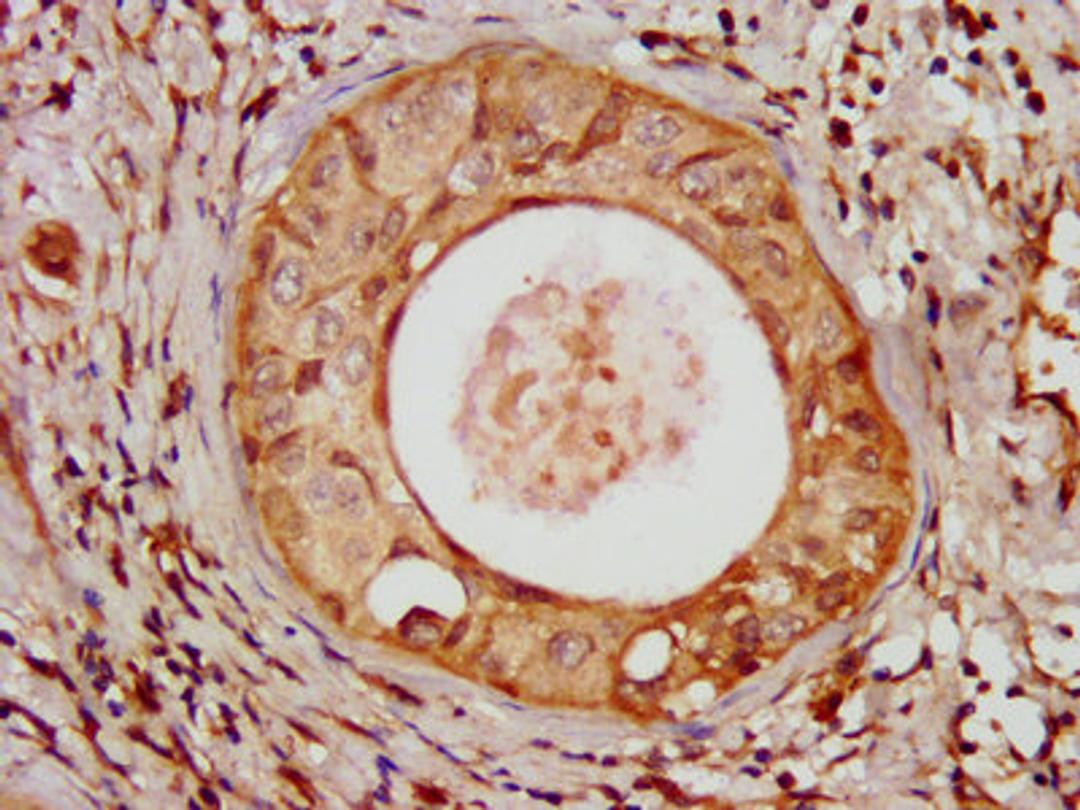 IHC image of CSB-PA728898LA01HU diluted at 1:100 and staining in paraffin-embedded human cervical cancer performed on a Leica BondTM system. After dewaxing and hydration, antigen retrieval was mediated by high pressure in a citrate buffer (pH 6.0). Section was blocked with 10% normal goat serum 30min at RT. Then primary antibody (1% BSA) was incubated at 4&deg;C overnight. The primary is detected by a biotinylated secondary antibody and visualized using an HRP conjugated SP system.