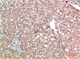 Immunohistochemical analysis of paraffin-embedded Human Liver Carcinoma Tissue using TTR Mouse mAb diluted at 1:200.