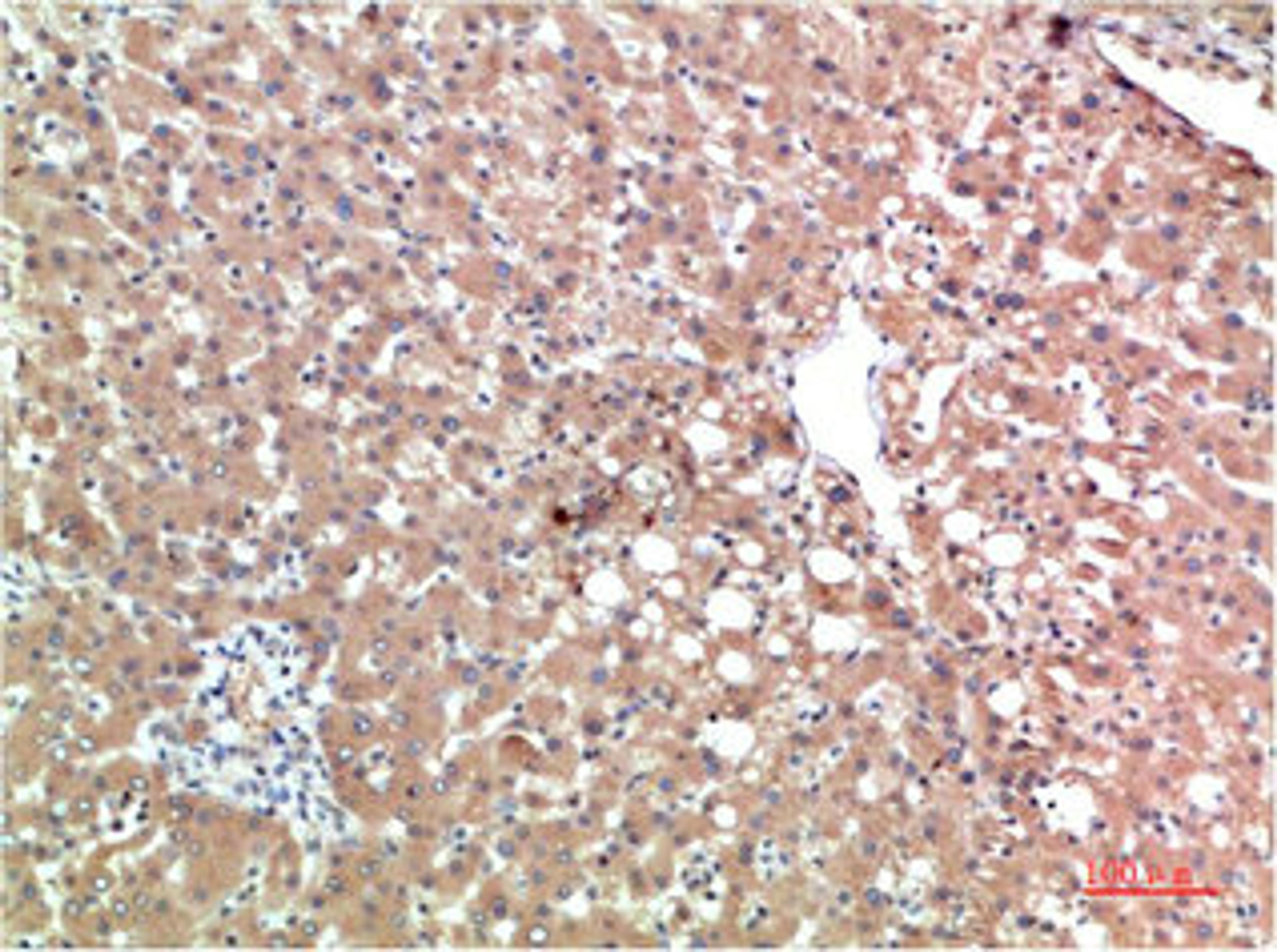 Immunohistochemical analysis of paraffin-embedded Human Liver Carcinoma Tissue using TTR Mouse mAb diluted at 1:200.