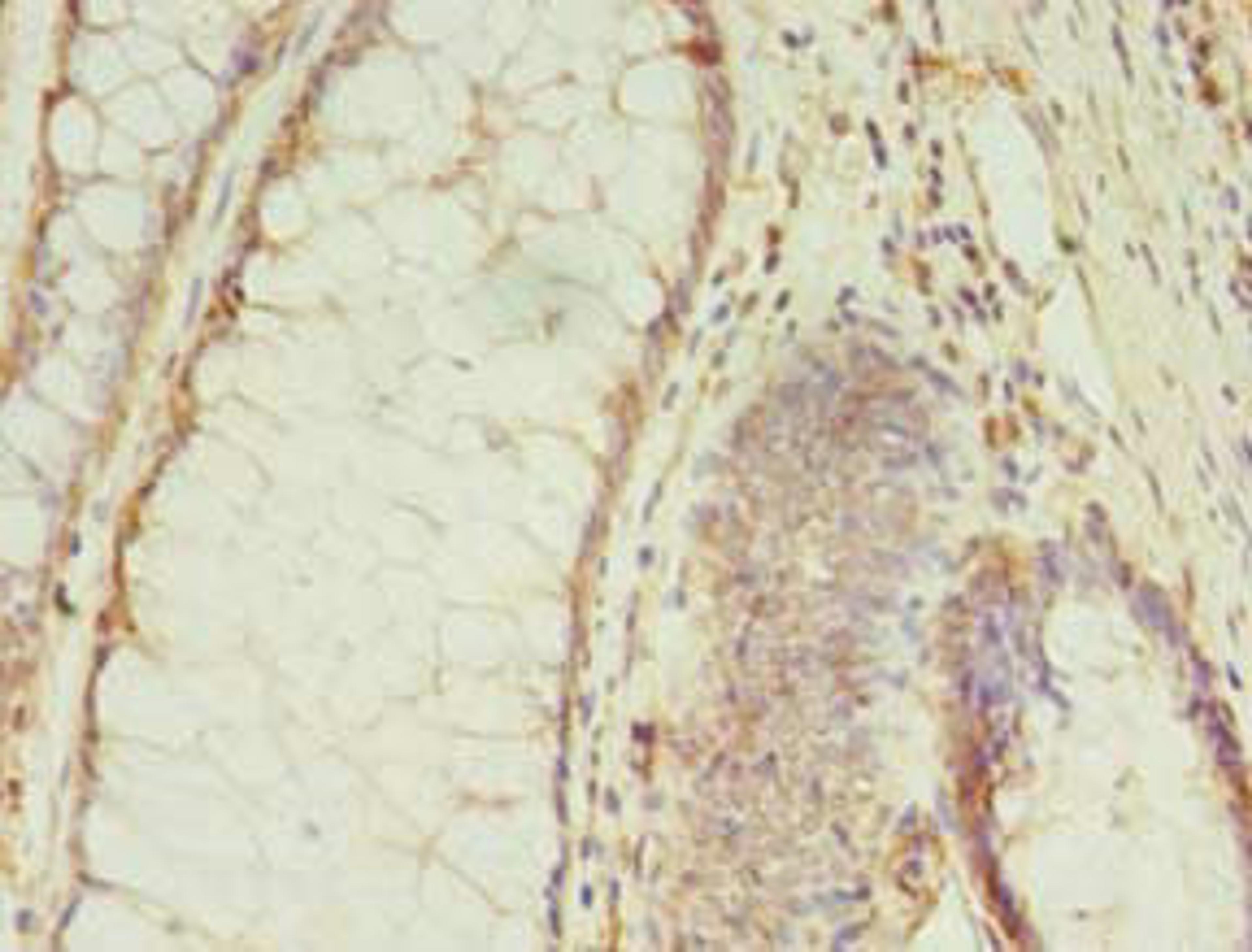 Immunohistochemistry of paraffin-embedded human colon cancer using CSB-PA875636LA01HU at dilution of 1:100