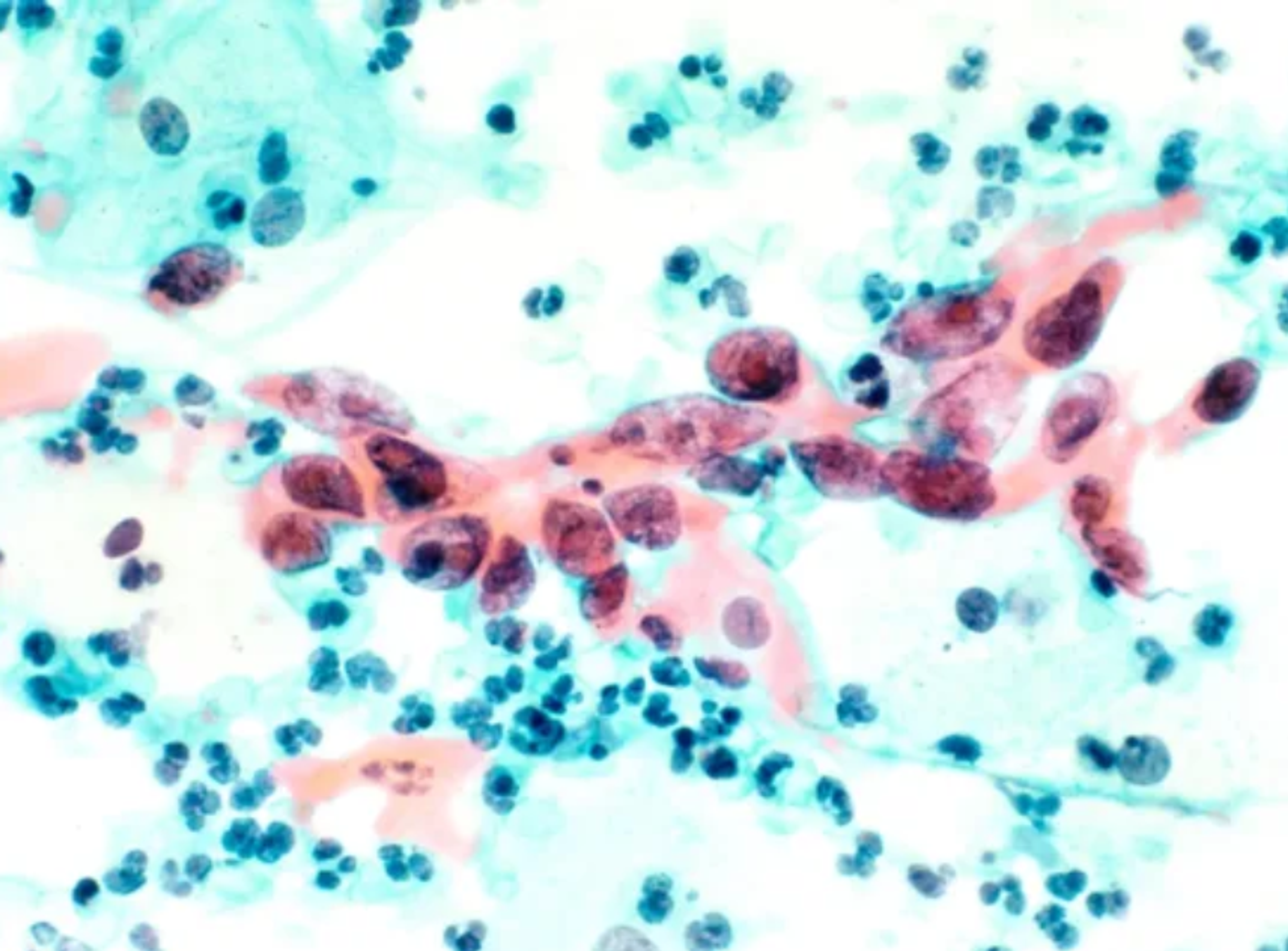 A magnified image of squamous cell carcinoma, the most common type of cervical cancer