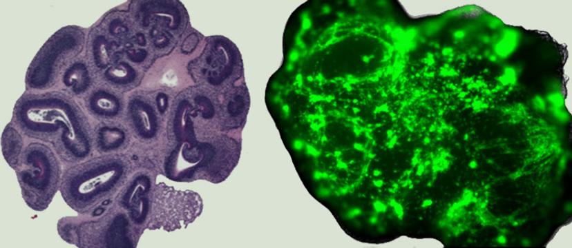 Normal and glioma cerebral organoids 