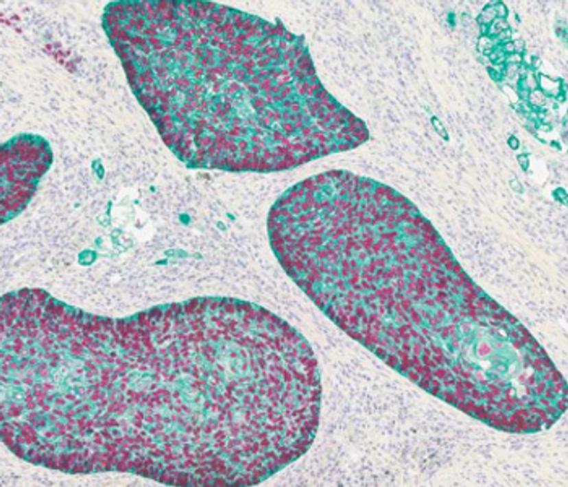 Slide image depicting lung p40, CK5, an example where spatial biology can help provide new insights into disease