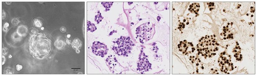 Kidney cancer organoids generated at University Hospital Zurich.