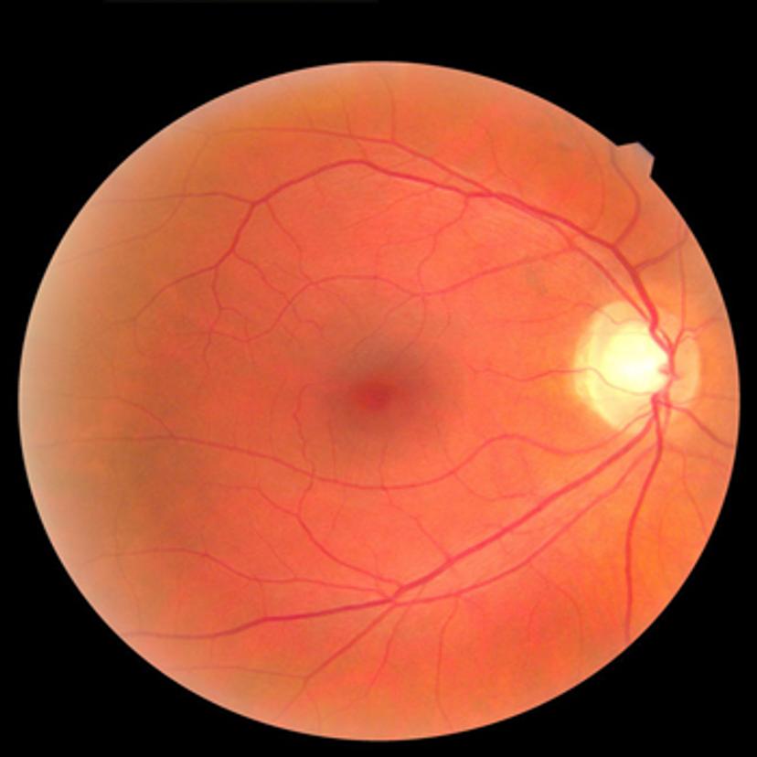 Eye Retina