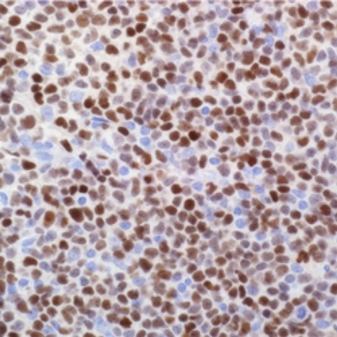 SOX-11 (MRQ-58) on mantle cell lymphoma.