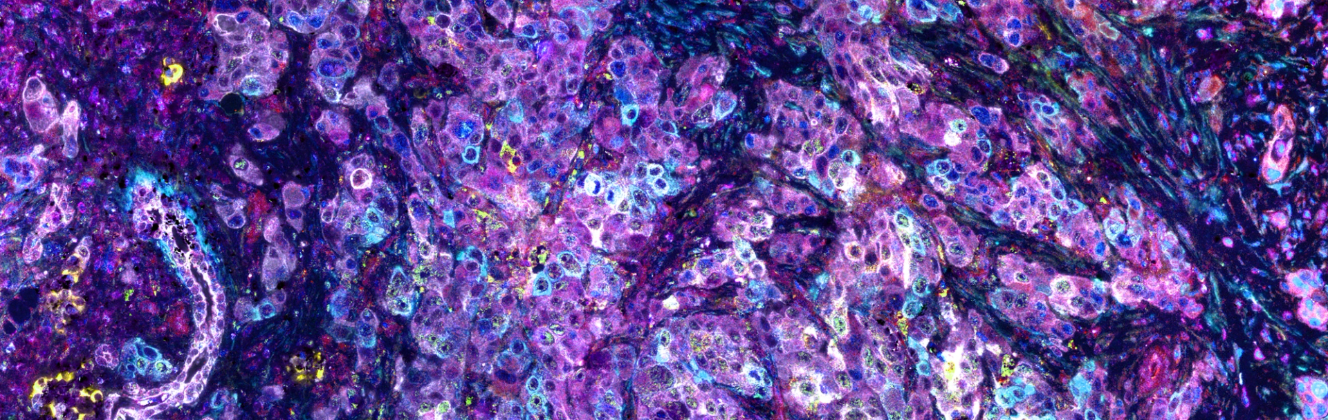  A section of pancreatic cancer tissue, highlighting cancer cells interspersed with stromal components, including fibroblasts and immune cells (resolution of 230 nm/pixel). These diverse cell populations were labeled with eleven distinct signals using seqIF™ technology, where each color corresponds to a different marker, illustrating the cells' functional states within the complex tumor microenvironment. Image was provided by Dr. Janusz Franco-Barraza and generated on COMET™.