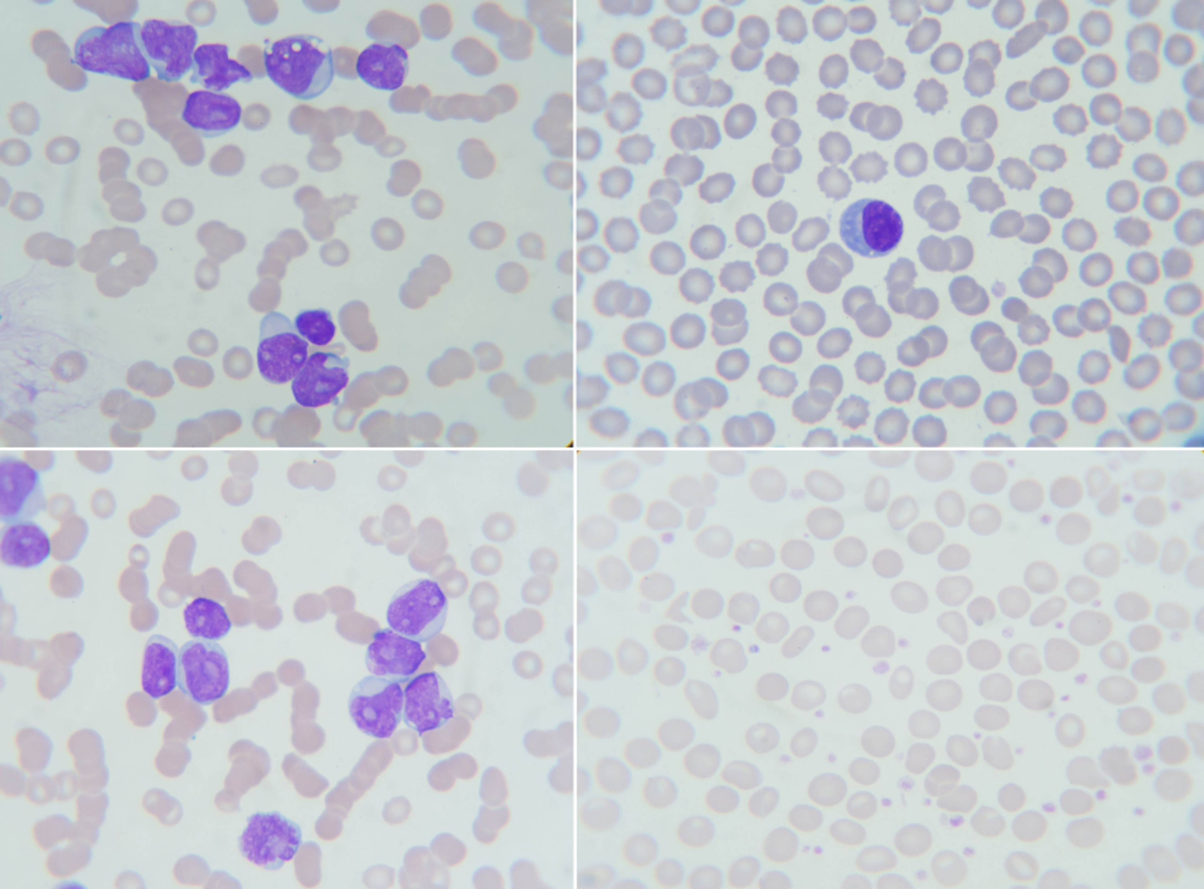 Blood film showing white cell leukemia morphology