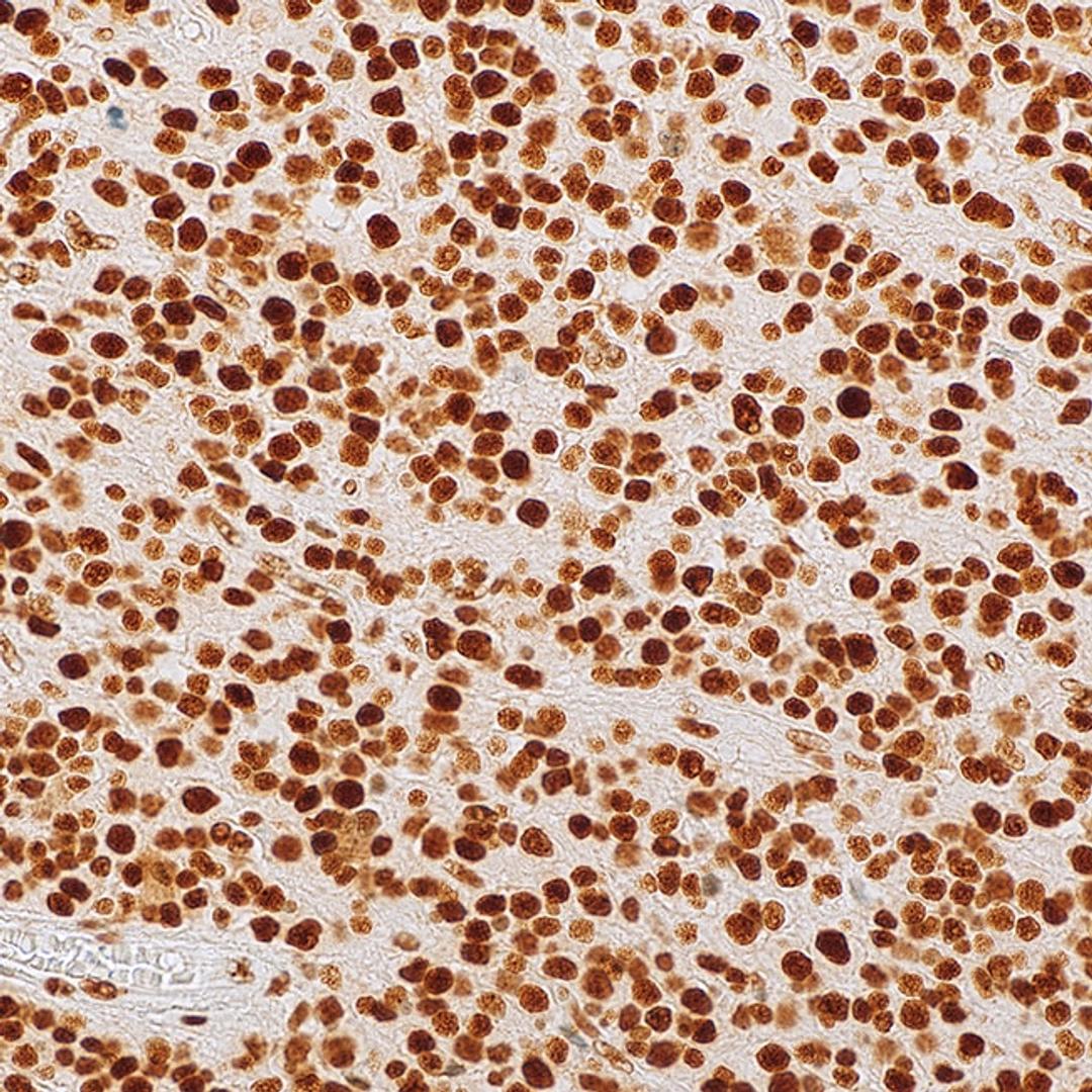 ATRX (polyclonal) on oligodendroglioma