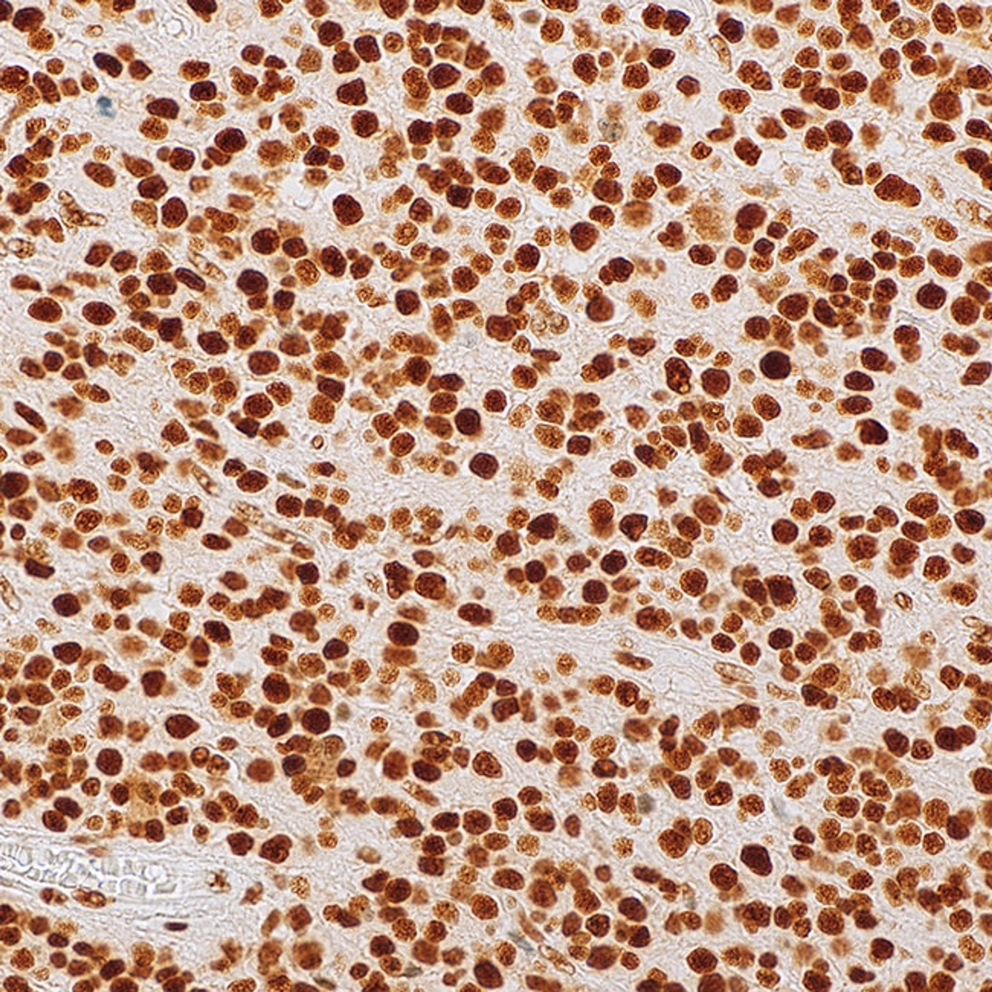 ATRX (polyclonal) on oligodendroglioma