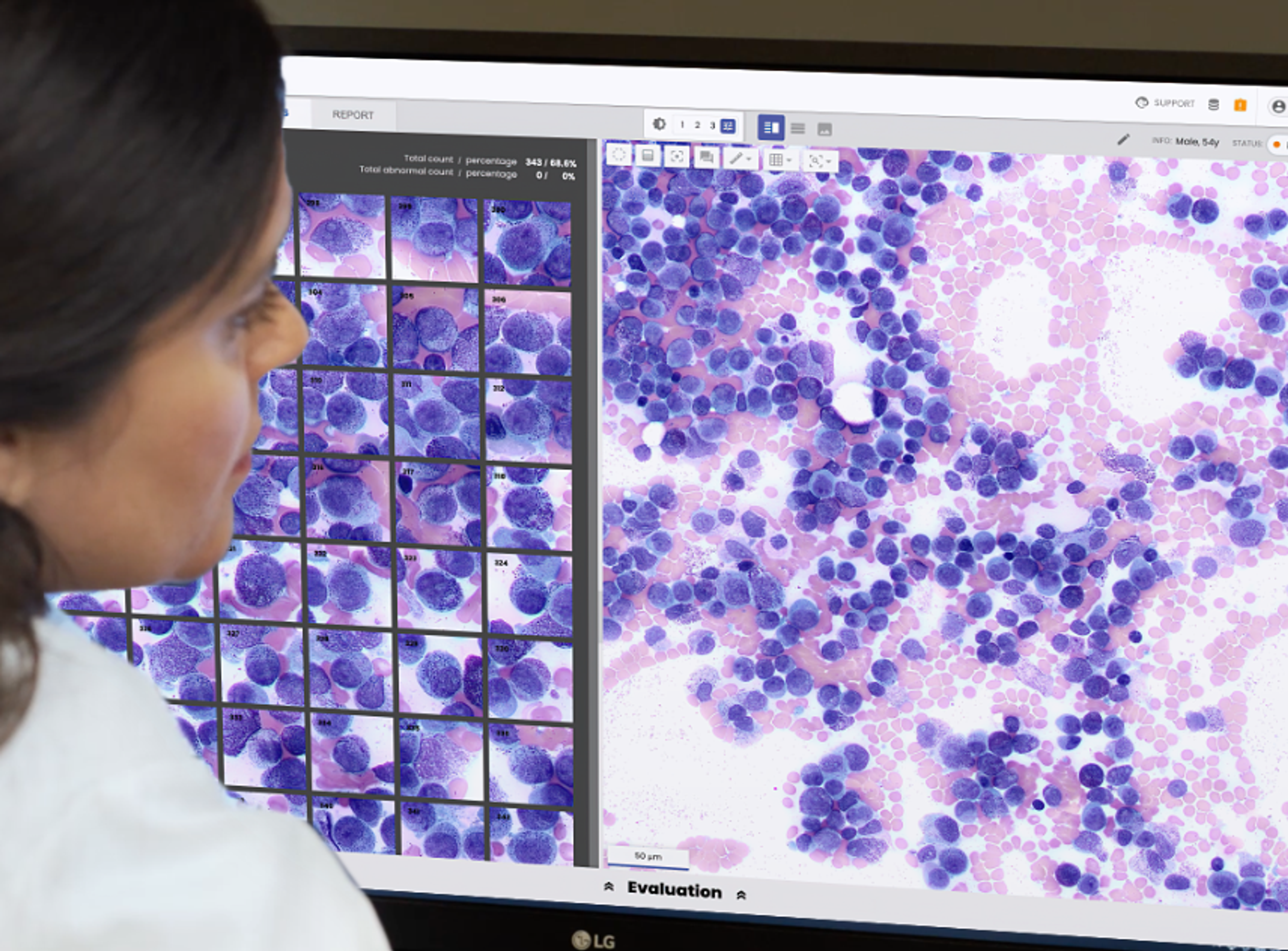 How AI-assisted digital workflows are transforming morphology review in the clinical laboratory