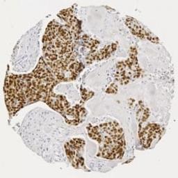 p53 staining in human squamous cell carcinoma.