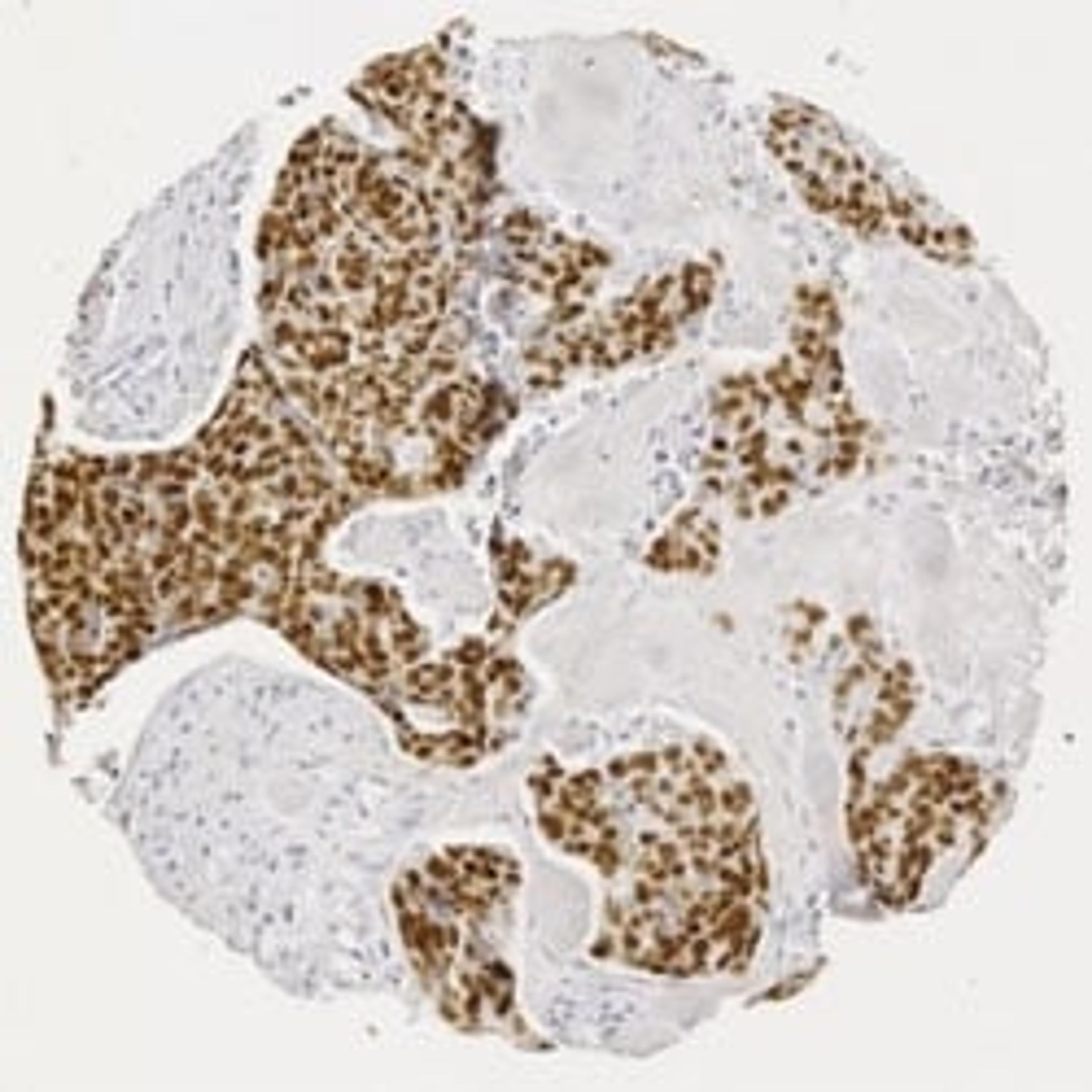 p53 staining in human squamous cell carcinoma.