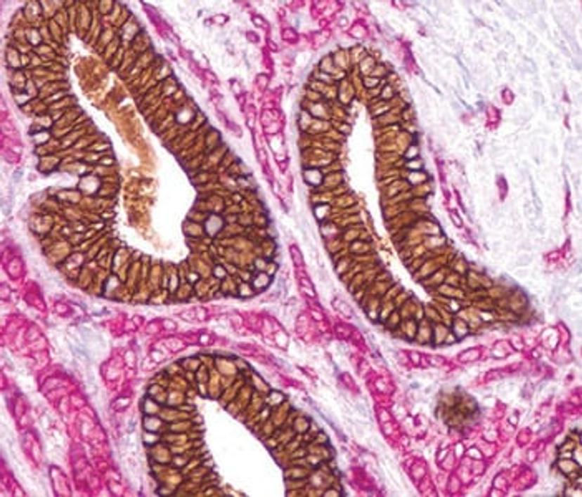 E-cadherin (brown), p120 (red) on lobular breast carcinoma