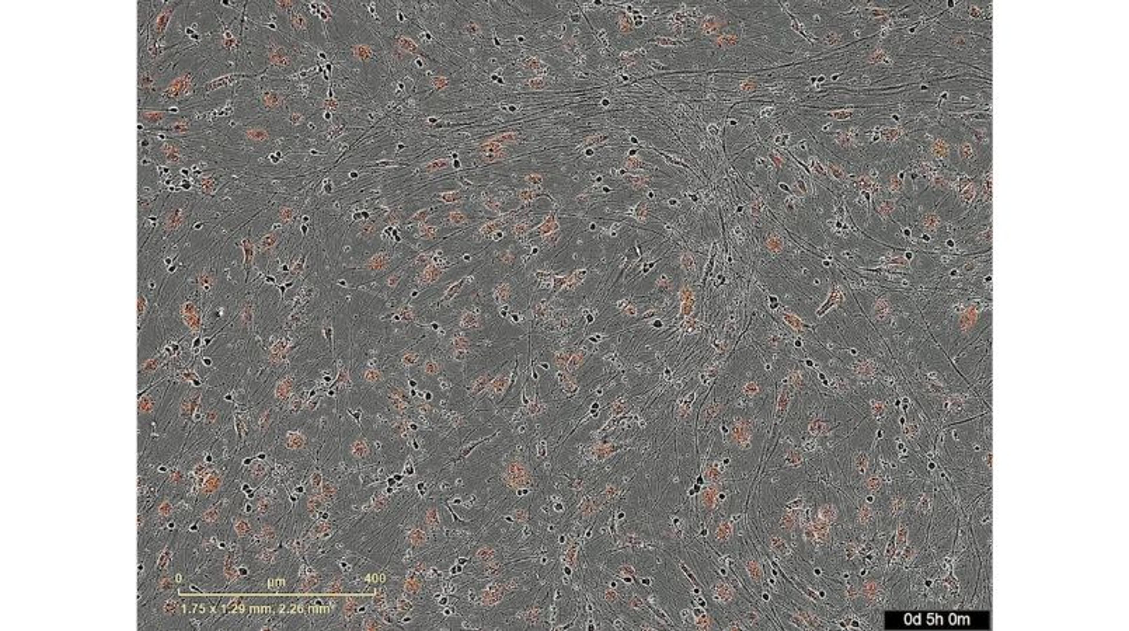 ioMicroglia phagocytosing pHrodo labelled Zymosan A BioParticles ioMicroglia phagocytosing pHrodo labelled Zymosan A BioParticles