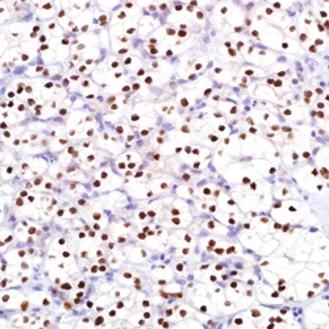 PAX-8 (MRQ) on clear cell renal cell carcinoma.