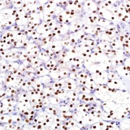 PAX-8 (MRQ) on clear cell renal cell carcinoma.