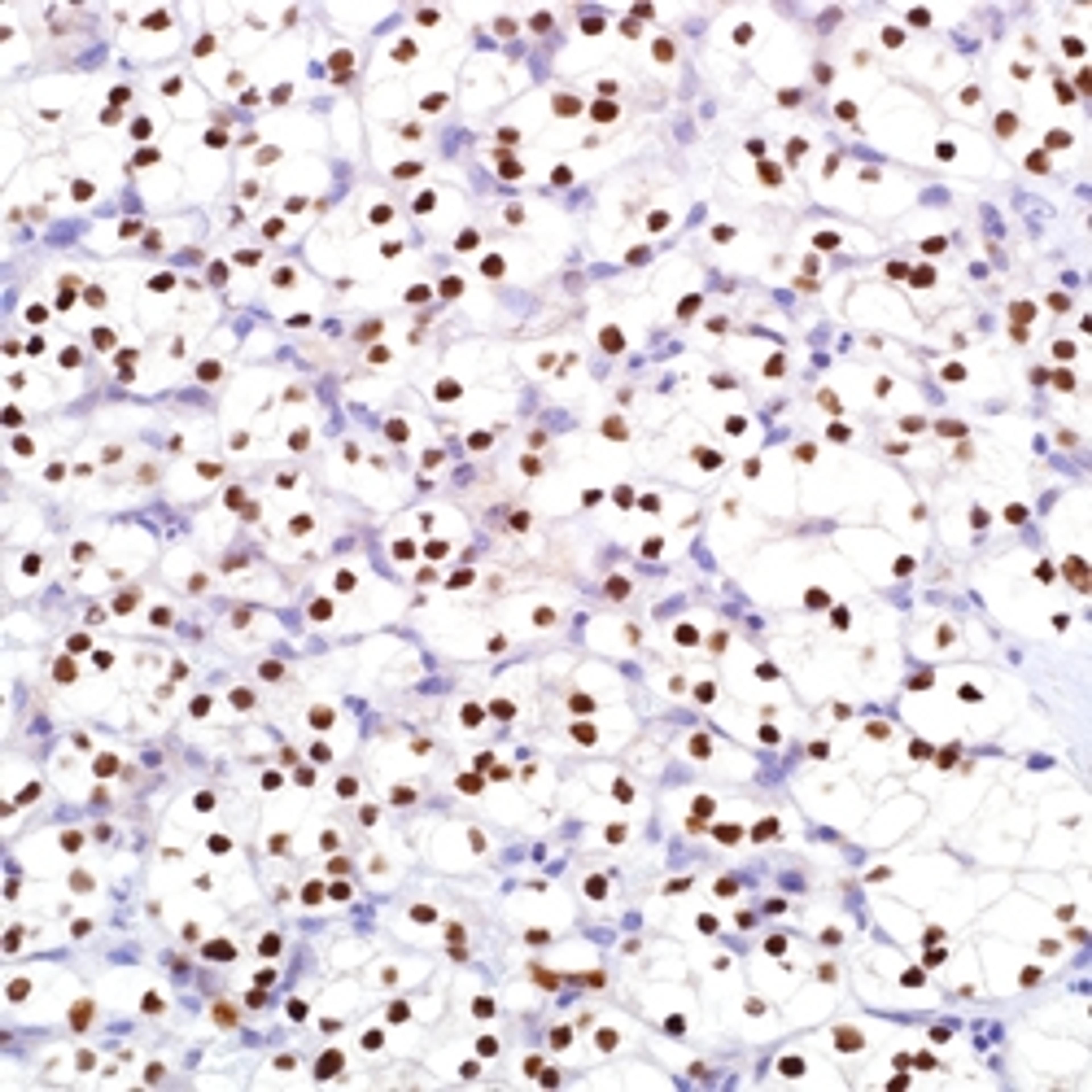 PAX-8 (MRQ) on clear cell renal cell carcinoma.