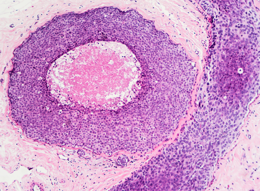 High RNA Quality FFPE Tissue Blocks for Biomarker Discovery