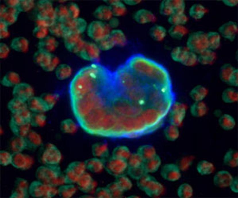 Tumor-derived endothelial cell cluster