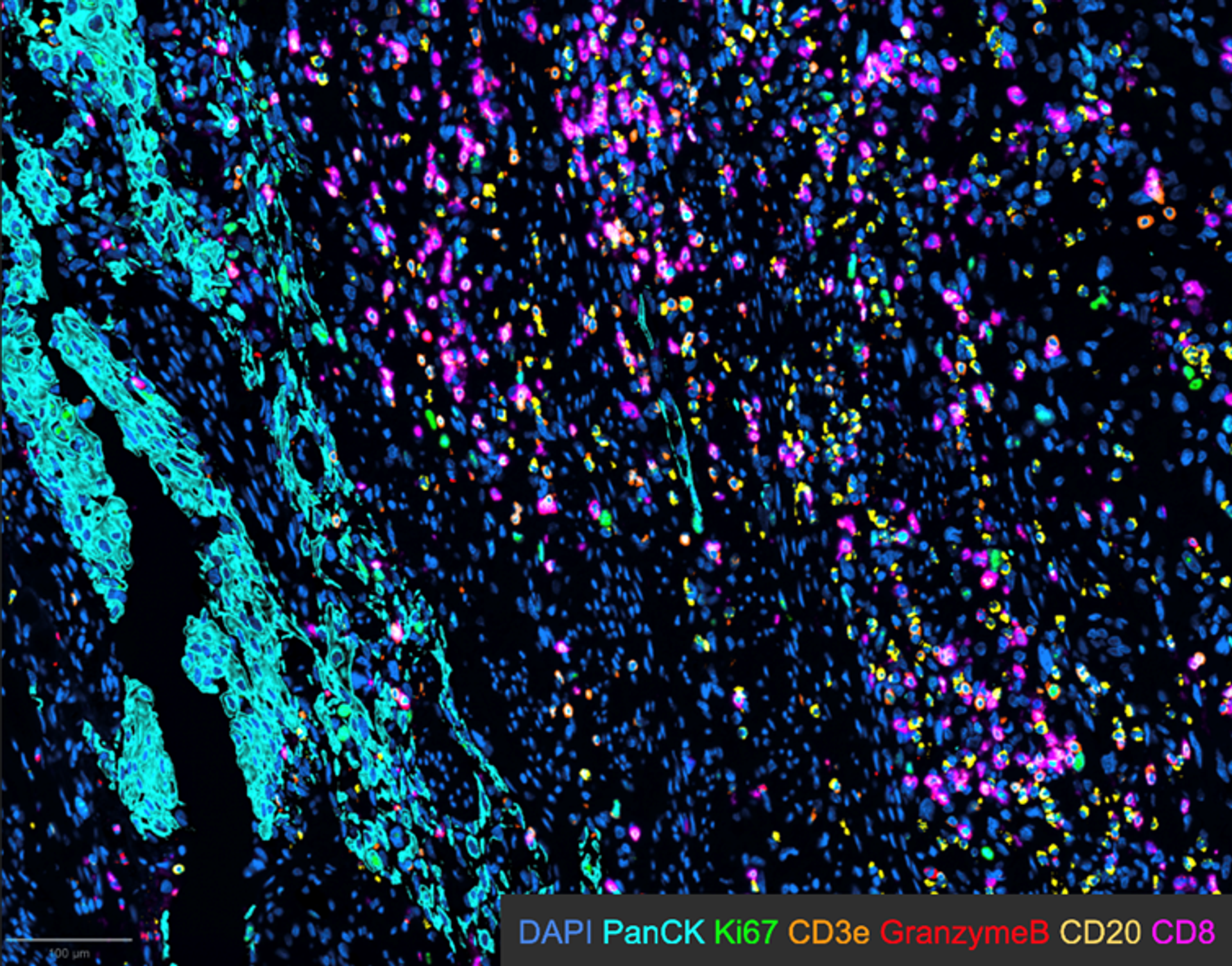 bladder cancer tissue section, with defined tumor areas from epithelial origin marked by PanCK (pancytokeratin - cyan), various immune cells (CD3, CD8, CD20) and some functional/proliferation markers (granzyme B, Ki67).