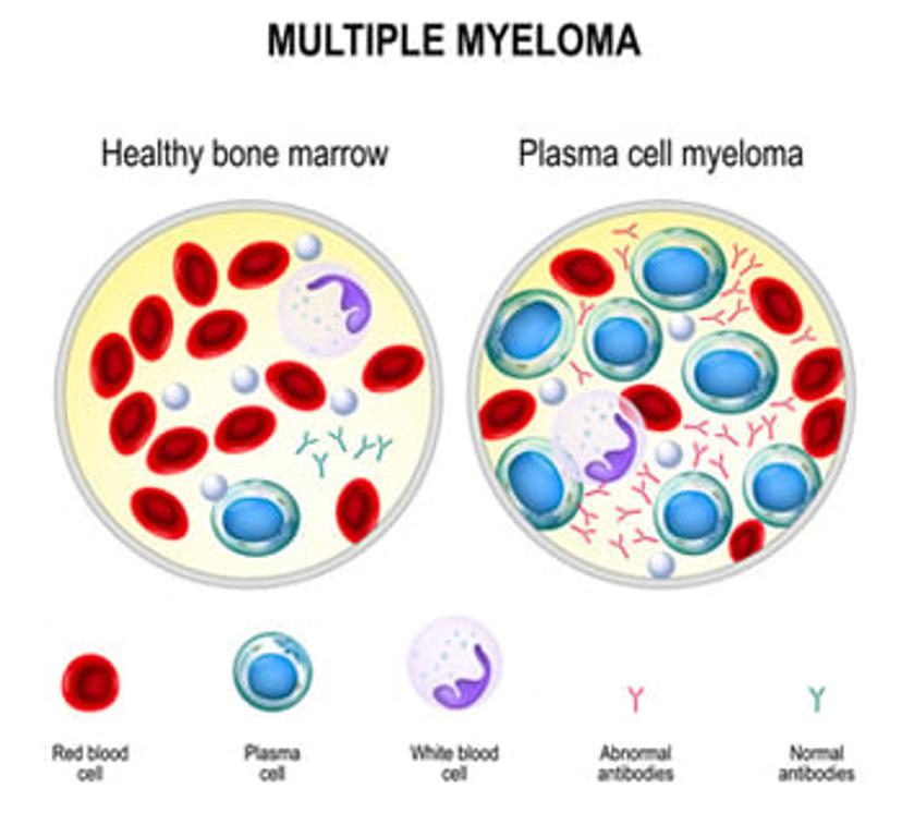 This diagram shows healthy bone marrow compared to bone marrow with plasma cell myeloma, with abnormal antibody and plasma cell accumulation.