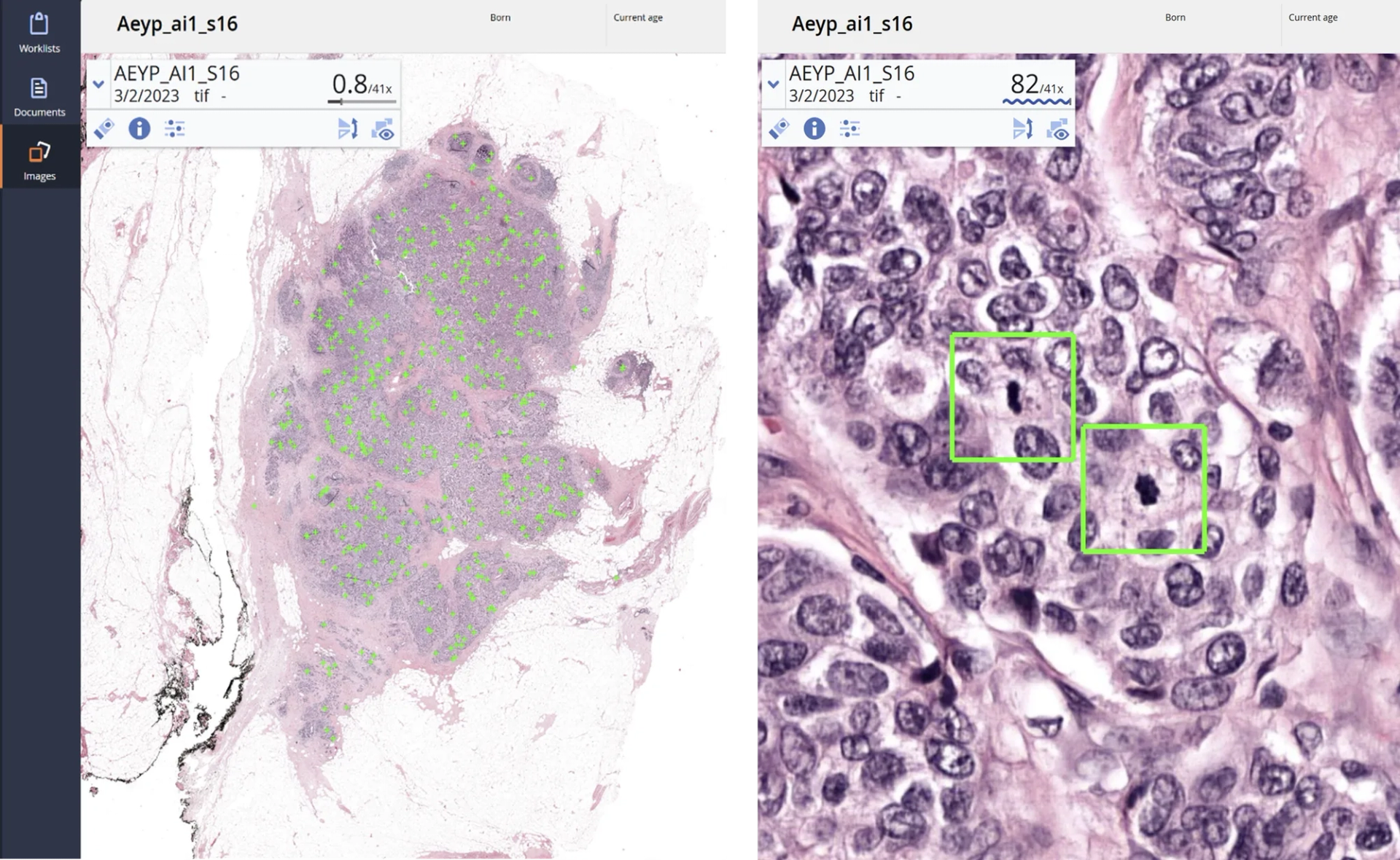 Mitotic figures detected and highlighted in a whole slide image of breast biopsy by Aiosyn Mitosis Breast.