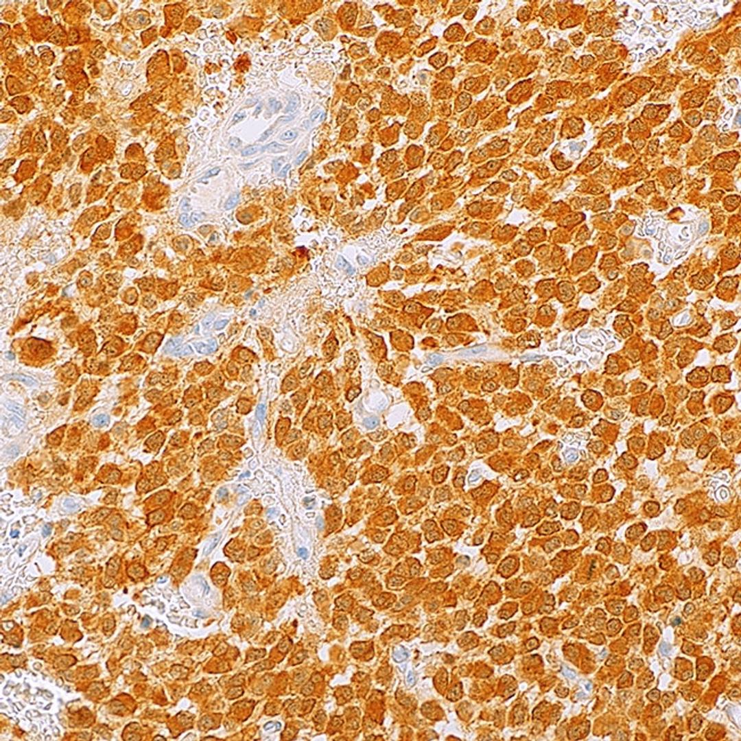 IDH1 R132H (MRQ-67) on astrocytoma