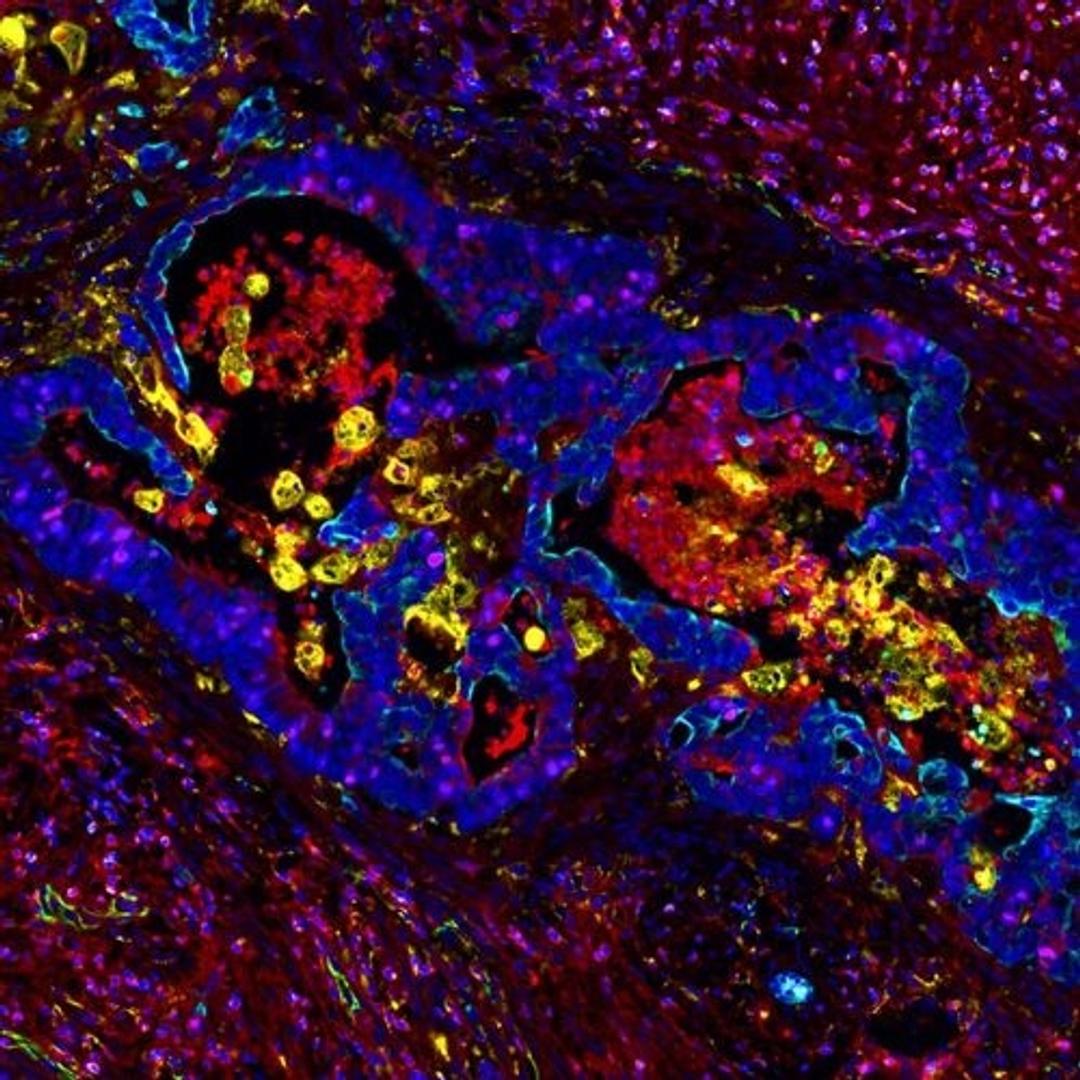 Whole slide section liver with metastasized CRC